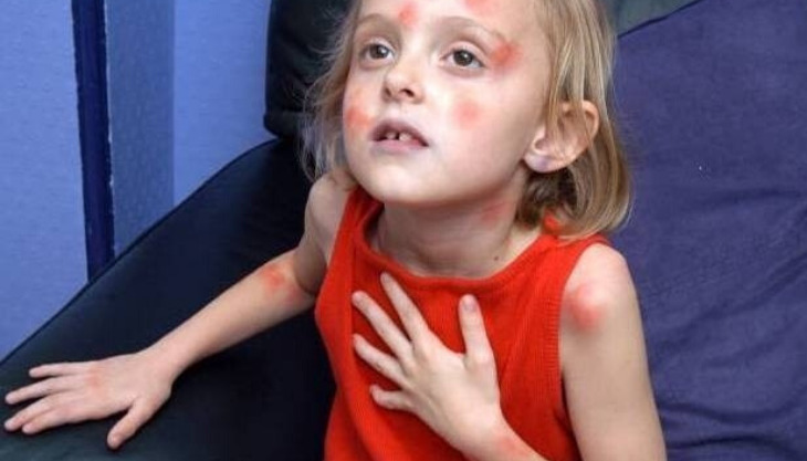 St John Ambulance – Severe Allergic Reaction